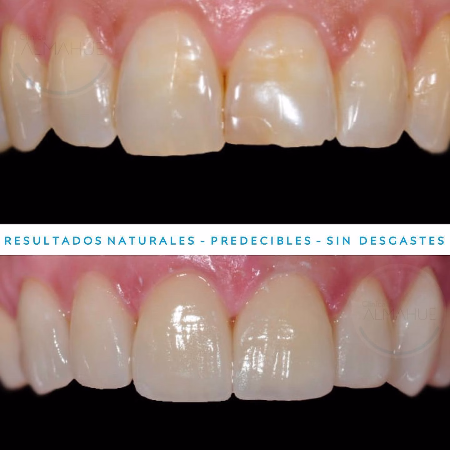 Caso de un paciente con diseño de sonrisa con carillas dentales.