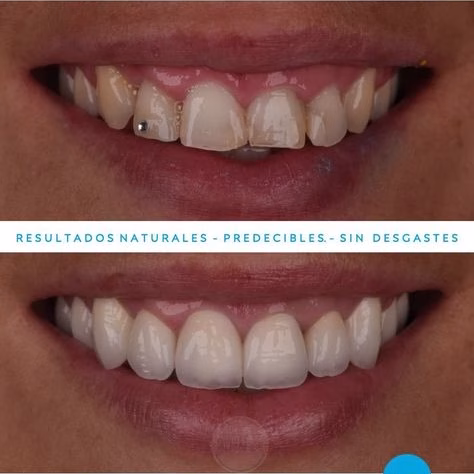 Caso de un paciente con diseño de sonrisa con carillas dentales.