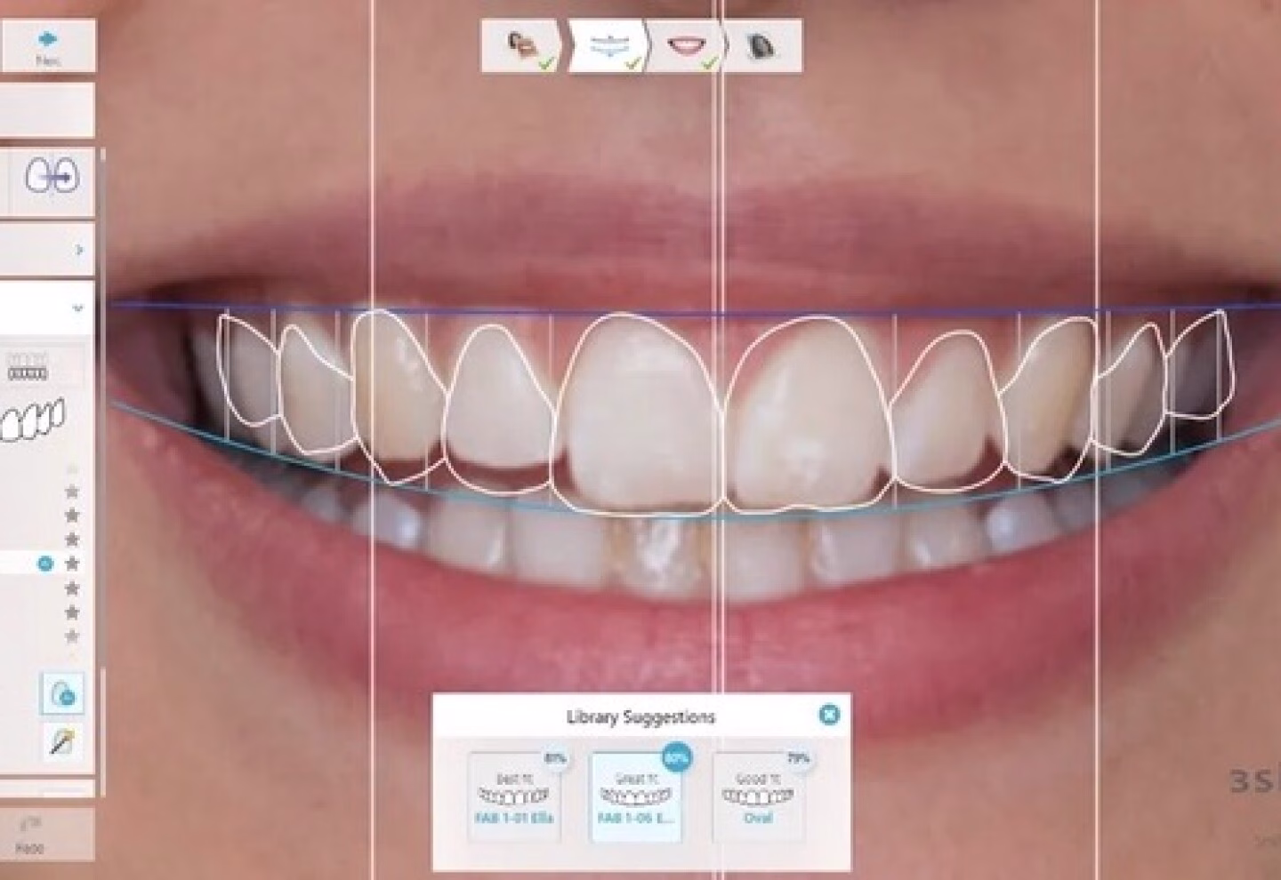 Caso de un paciente con diseño de sonrisa con carillas dentales.